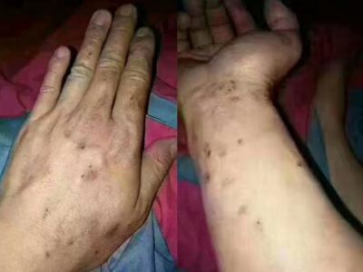 使用劣質真瓷膠做美縫，后果自負！